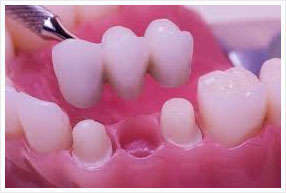 How is a bridge placed