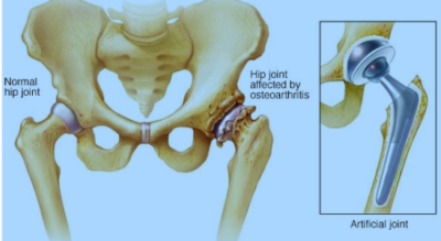 Hip Replacement Surgery in Costa Rica