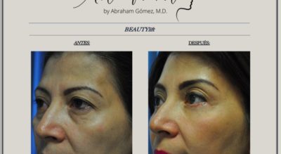 Endoscopic Forehead and  Brow Lift