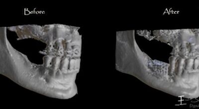 What are Custom Dental Implants?