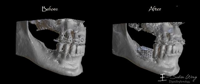 What are Custom Dental Implants - Costa Rica